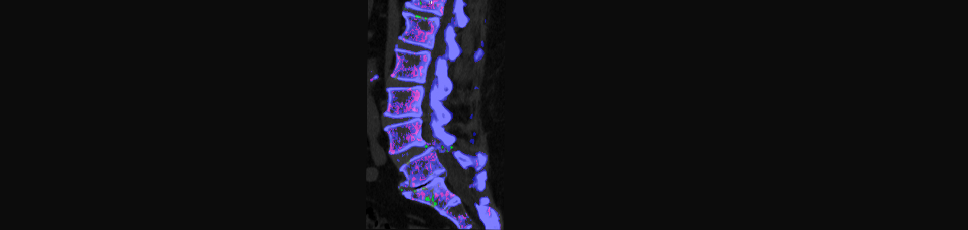 Dr. Paulette Hugulet, DC, LLC is aware that inflammatory spinal gout is a differential diagnosis to consider for patients who present with back pain and other spine related symptoms.