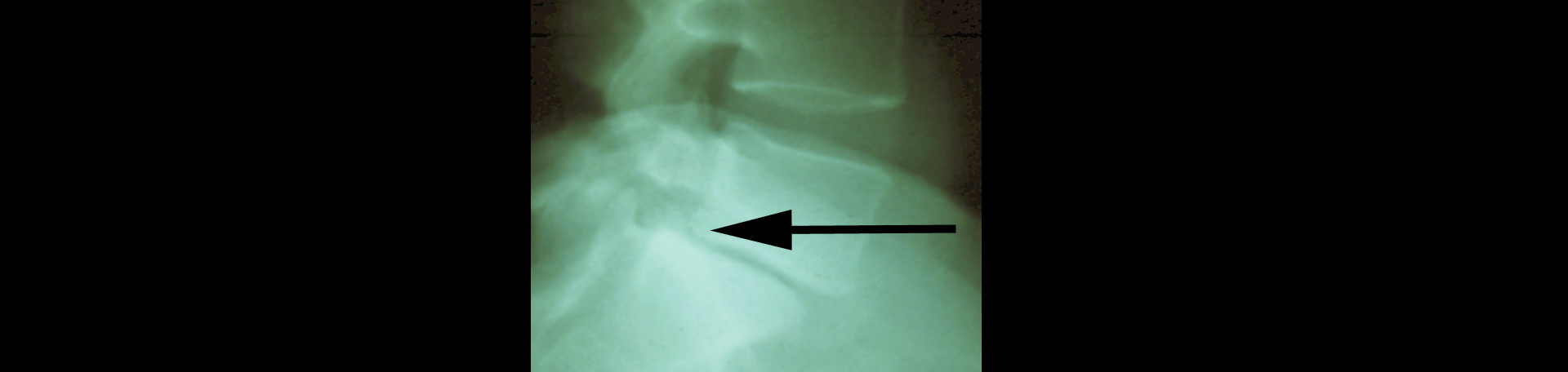 La Grande spondylolisthesis 