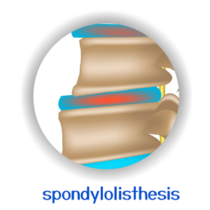 picture of La Grande chiropractic spondylolisthesis